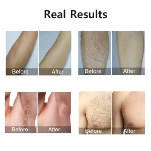 Painless IPL Laser Epilator 999999 Flashes – Permanent Hair Removal for Face, Arms, Legs, and Bikini Line Painless and Effective